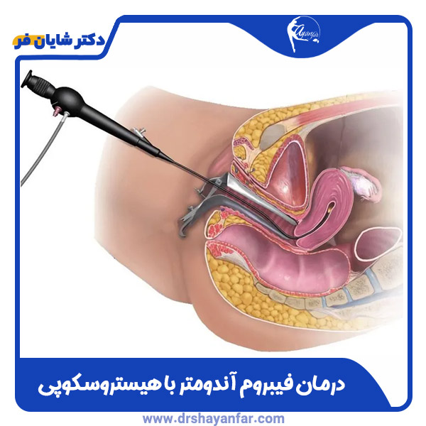 درمان فیبروم آندومتر با هیستروسکوپی