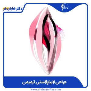 جراحی ترمیمی لابیاپلاستی