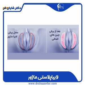 لابیاپلاستی ماژور