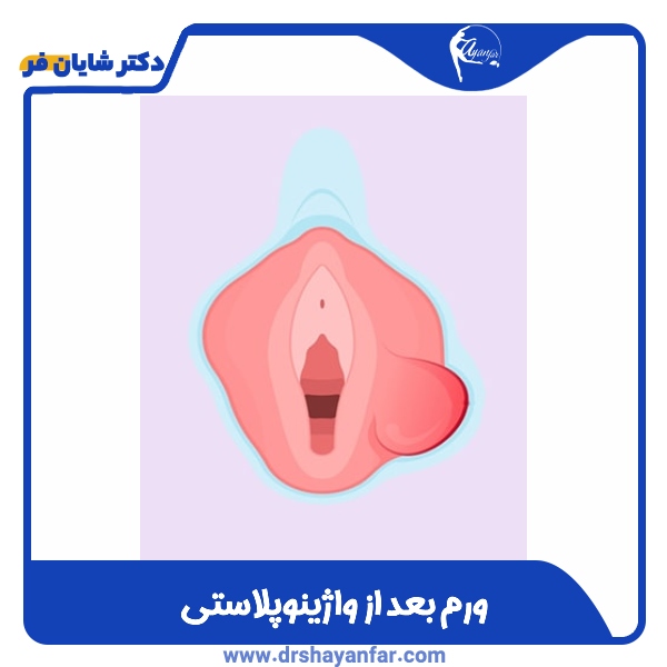 ورم بعد از واژینوپلاستی