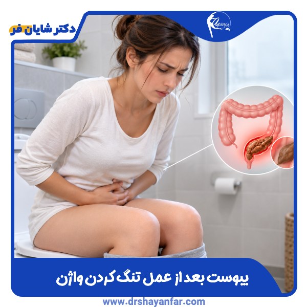 یبوست بعد از عمل تنگ کردن واژن