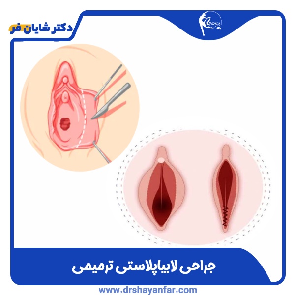 عمل همزمان لابیاپلاستی و پرینورافی